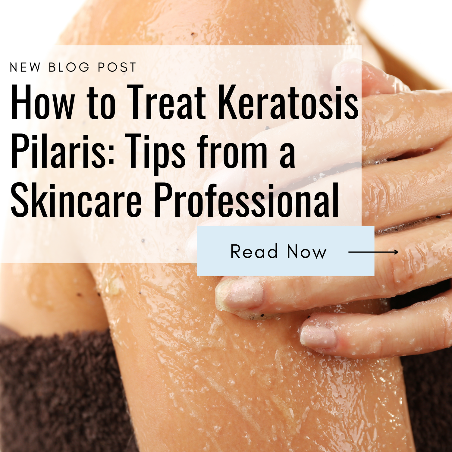 How to Treat Keratosis Pilaris: Tips from a Skincare Professional