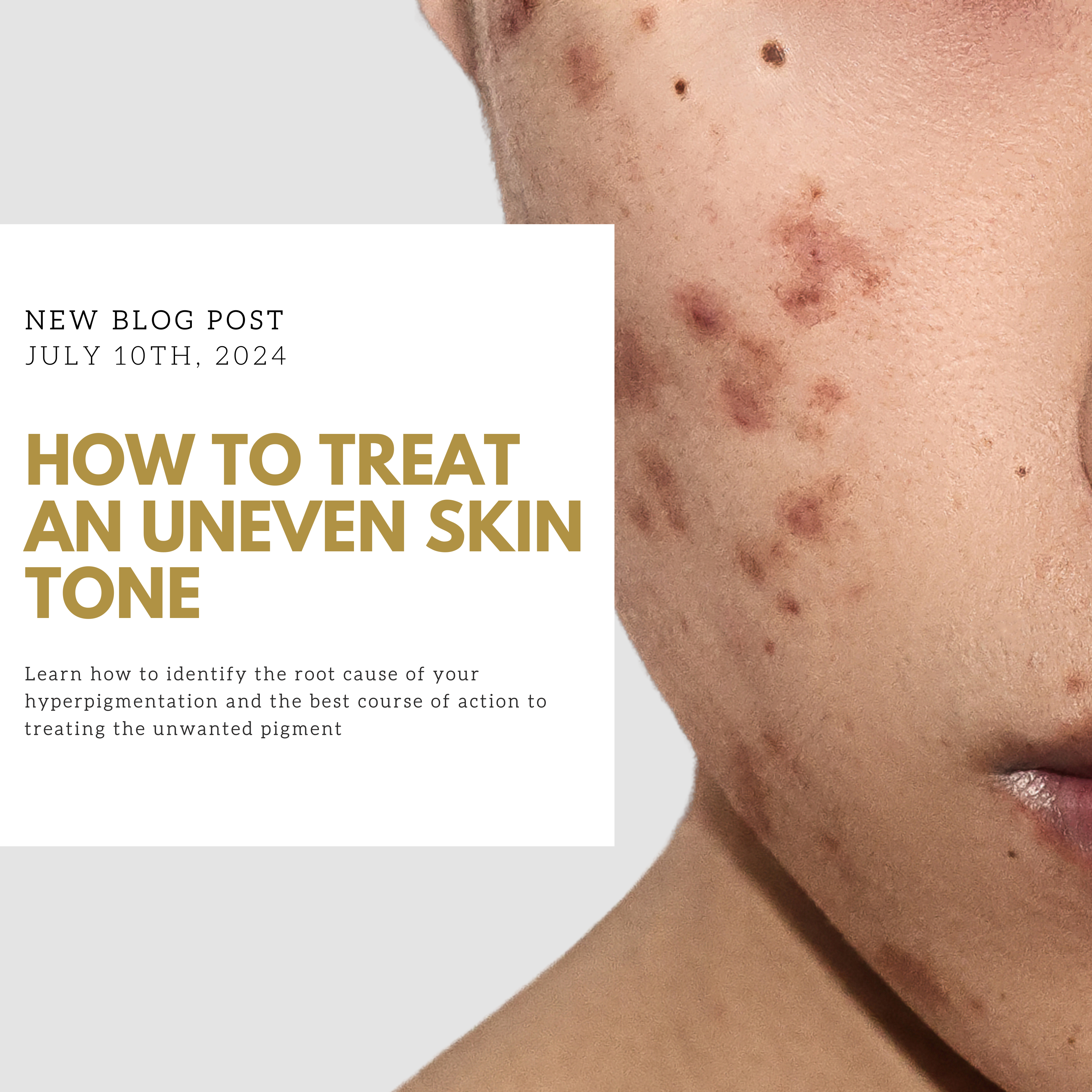 How to treat Hyperpigmentation | Everything you need to know