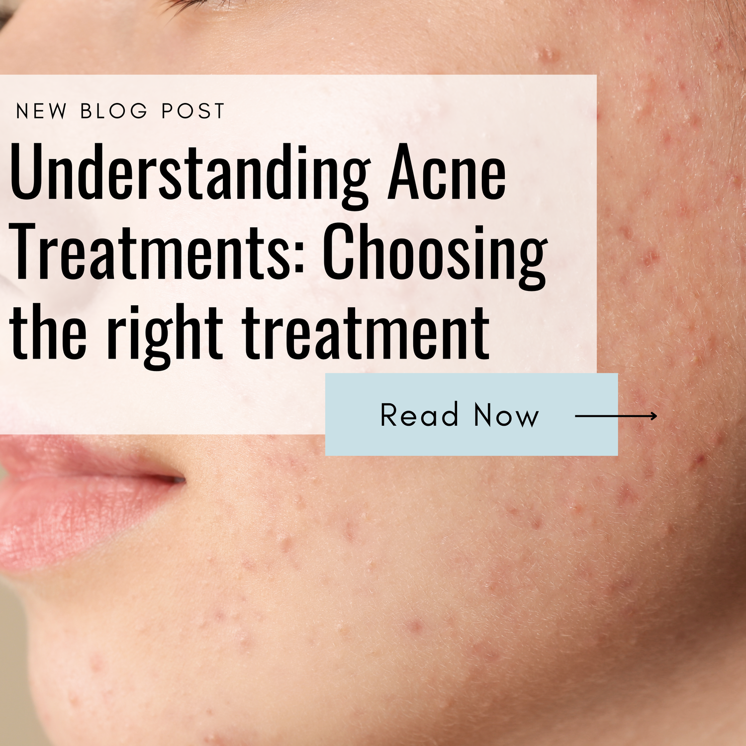 Understanding Acne Treatments: Choosing the Right Solution for Your Skin Type