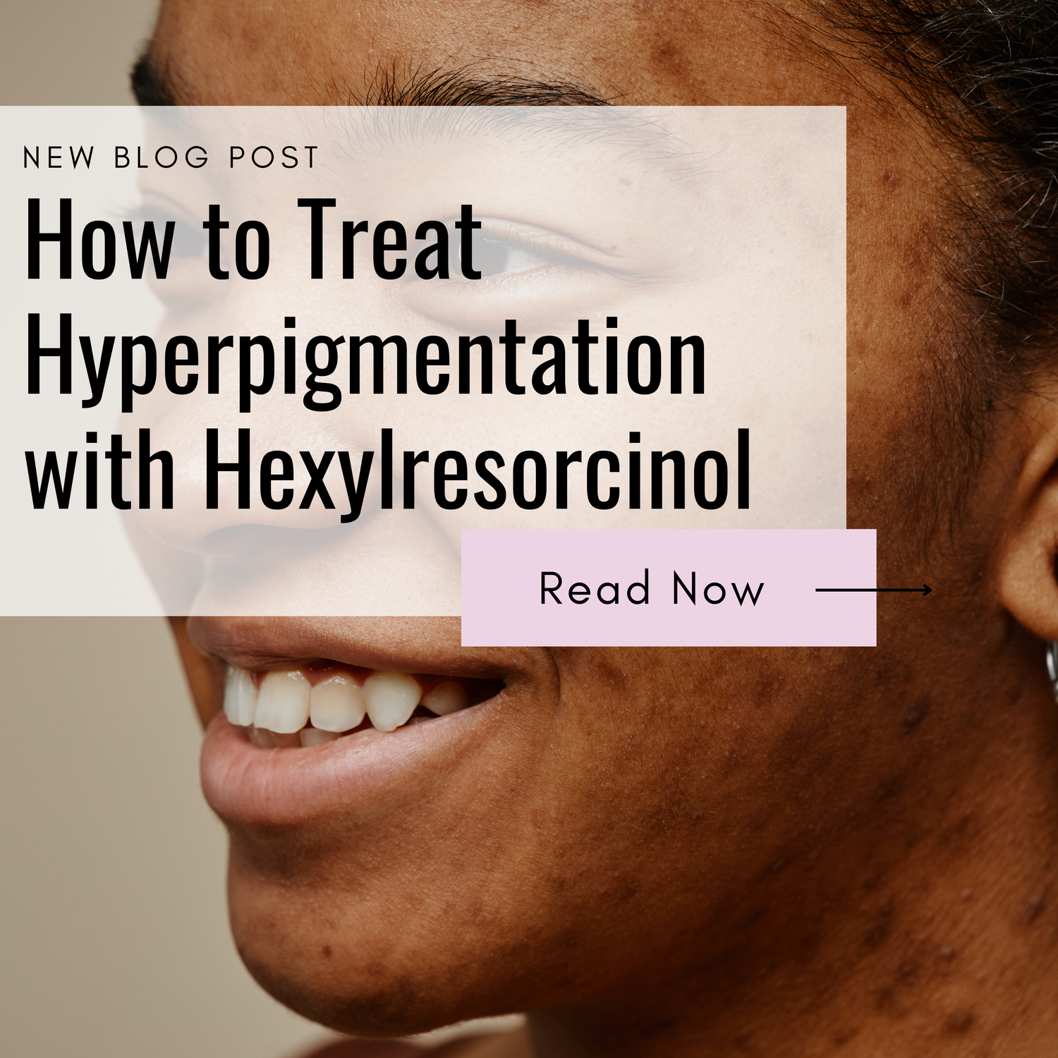 How to Treat Hyperpigmentation with Hexylresorcinol