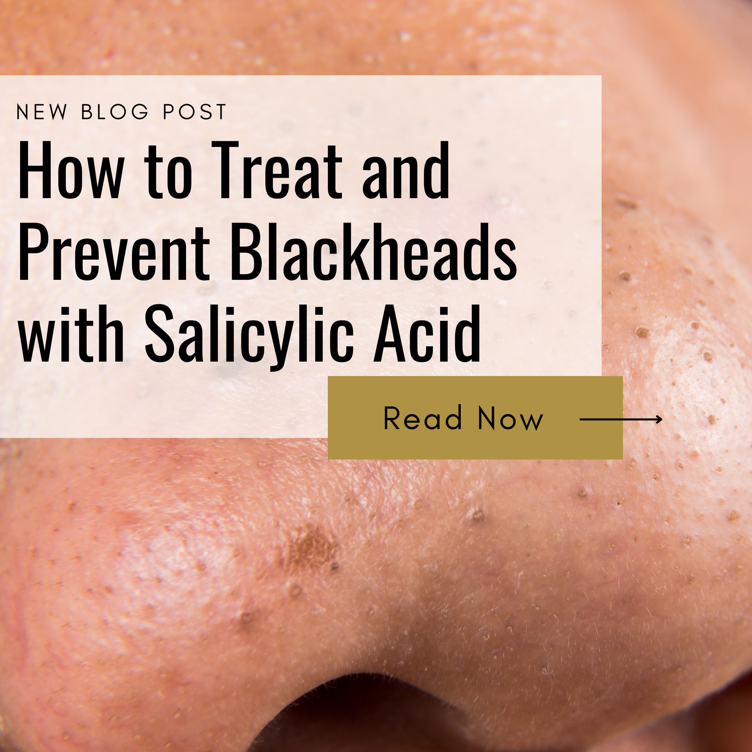 How to Treat and Prevent Blackheads with Salicylic Acid