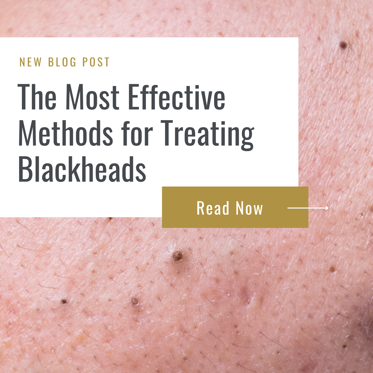 tips for treating blackheads| how to treat blackheads