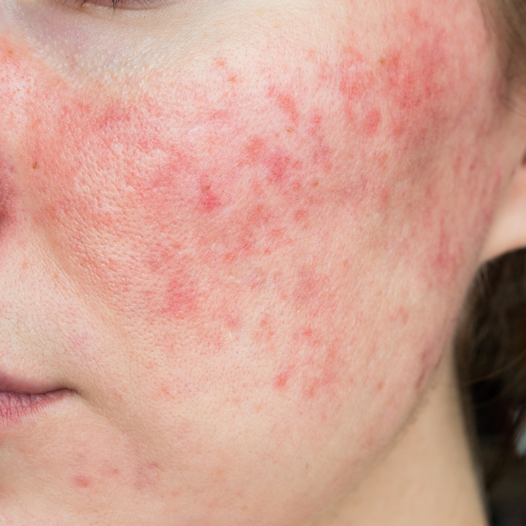 Shop skincare for rosacea 